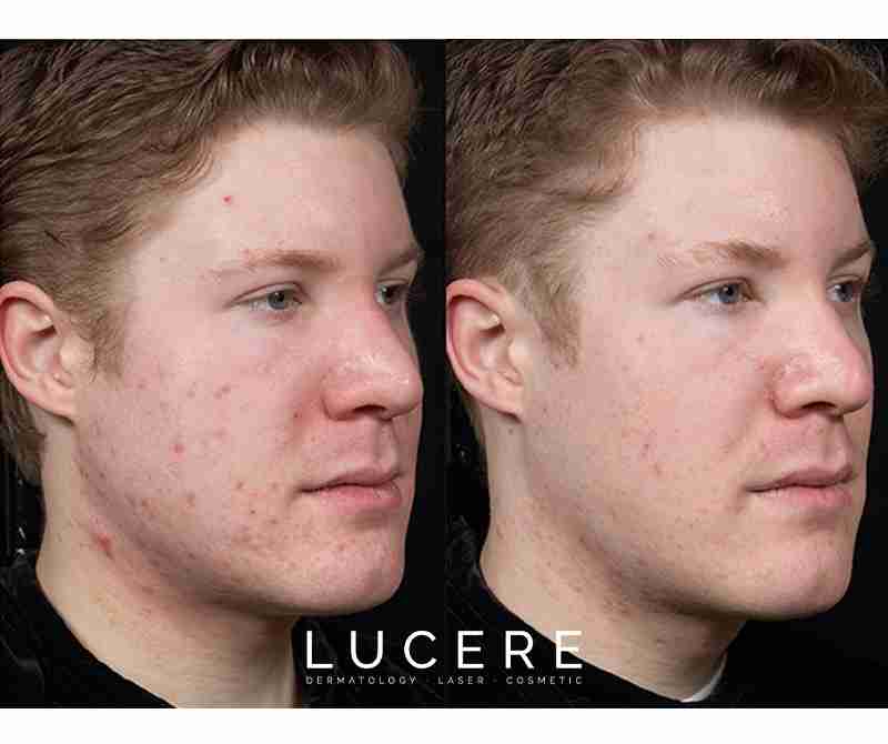 New PostUnmasking the Mystery of Acne Treatment: Clear Skin